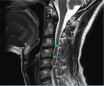 安静時にも起こる手の痺れ 頚椎ヘルニア | ブログ | アギトス鍼灸整骨院